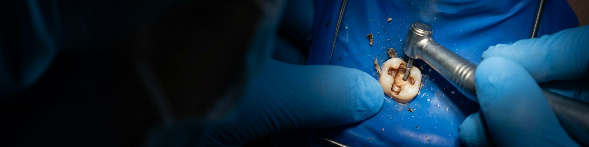 Dental drill being used on tooth with cavity surrounded by dental dam.